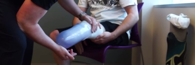 When Was the Prosthetic Leg Invented When Was the Prosthetic Leg Invented